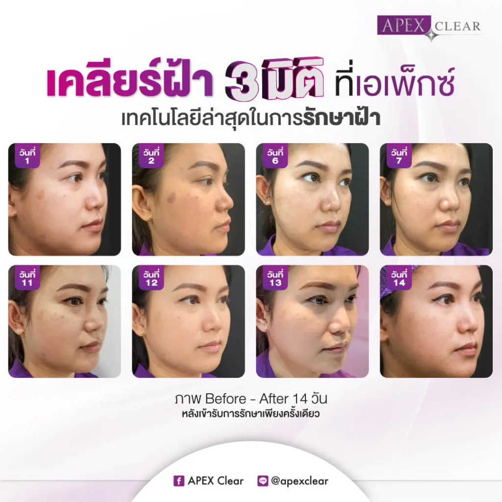 เลเซอร์ฝ้า