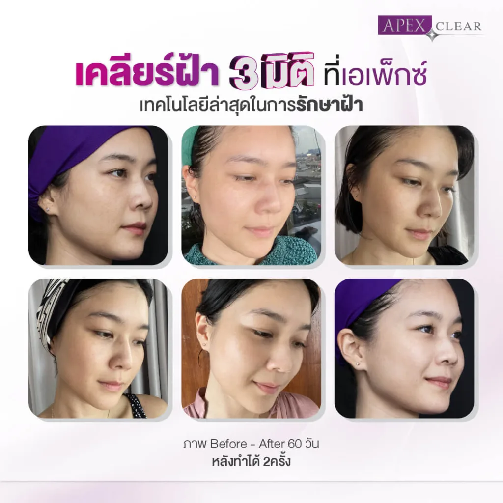 เลเซอร์ฝ้า