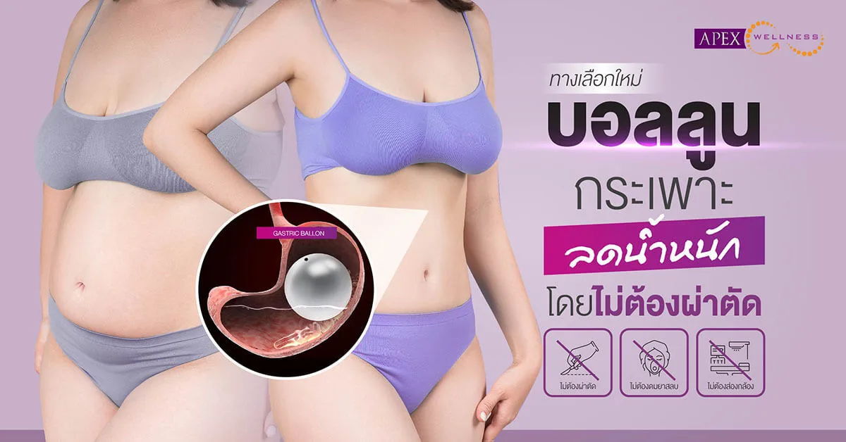 Gastric Balloon (บอลลูนลดน้ำหนัก)​