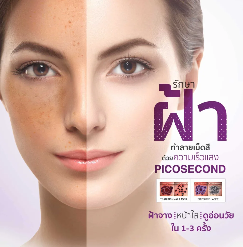 เลเซอร์ฝ้า