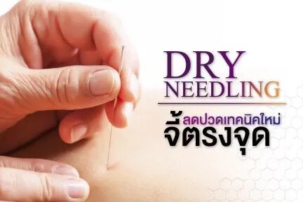 dry needling
