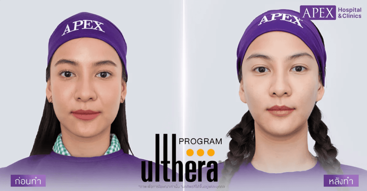 รีวิว Ulthera