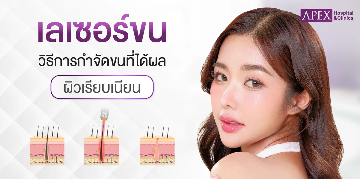 เลเซอร์กำจัดขน
