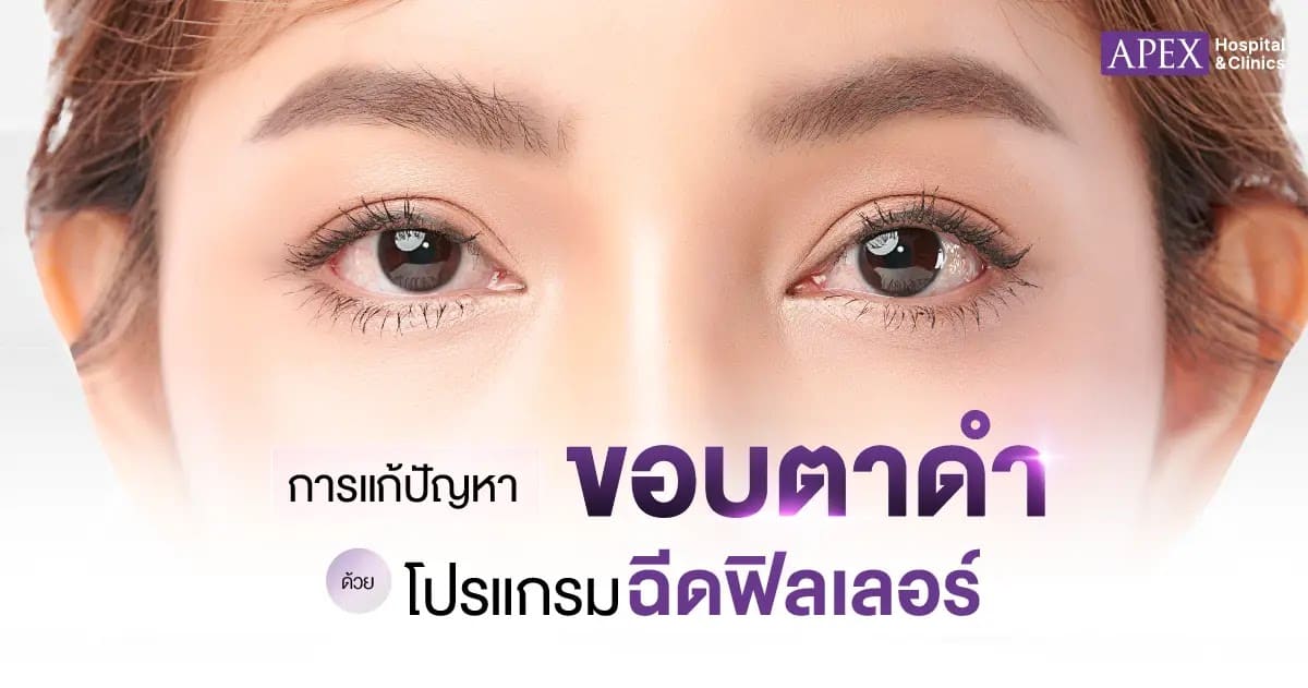 แก้ขอบตาดำด้วยฟิลเลอร์