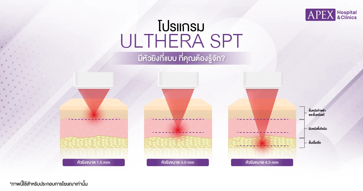 Ulthera SPT มีกี่แบบ