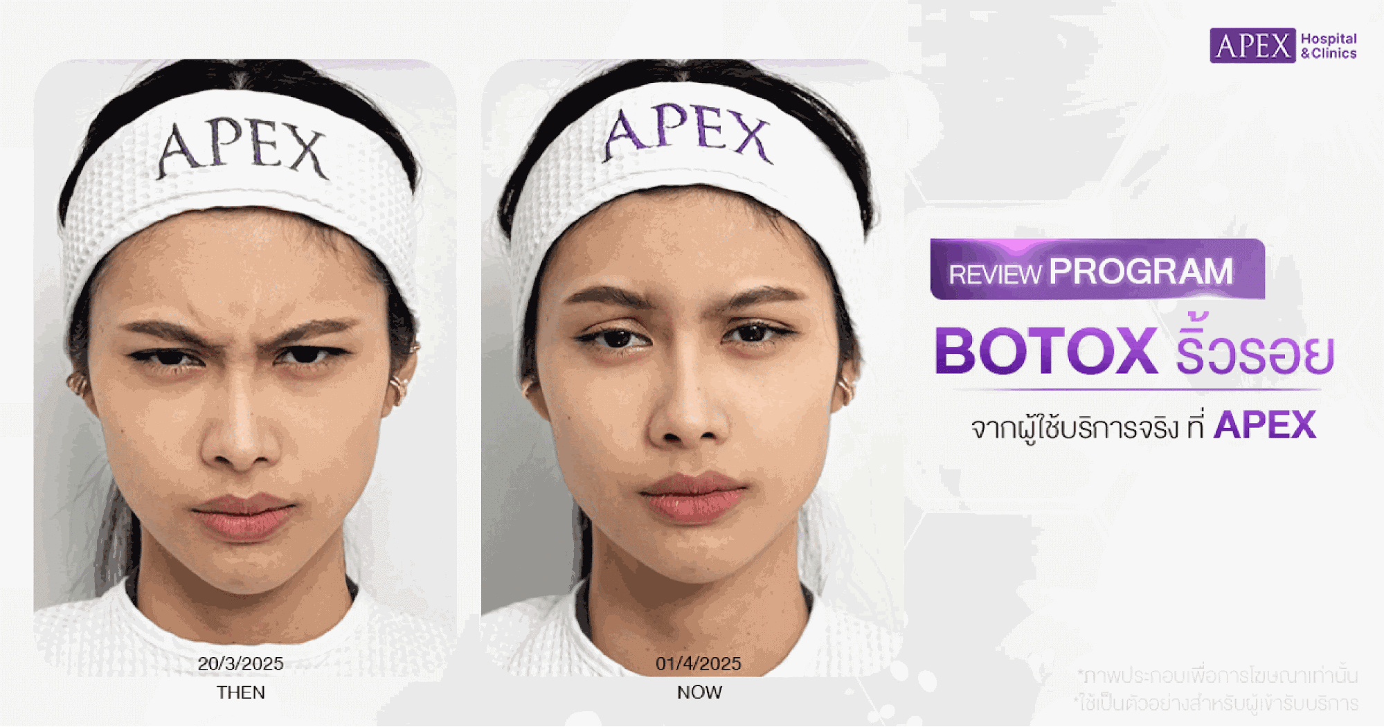 รีวิวฉีดโบท็อกลดริ้วรอย APEX