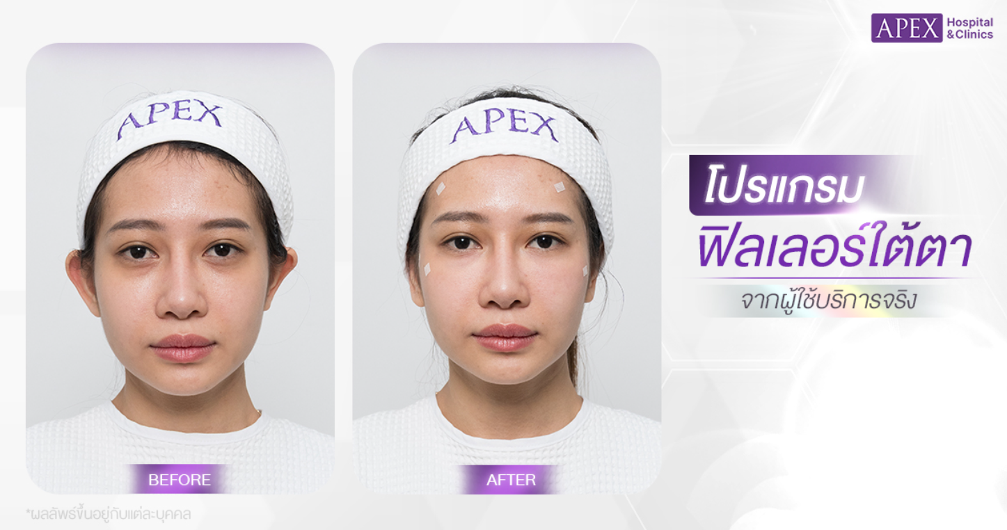 รีวิวฉีดฟิลเลอร์ใต้ตา