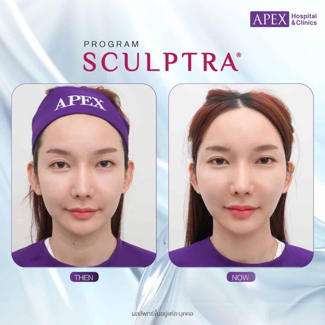 รีวิวโปรแกรม Sculptra