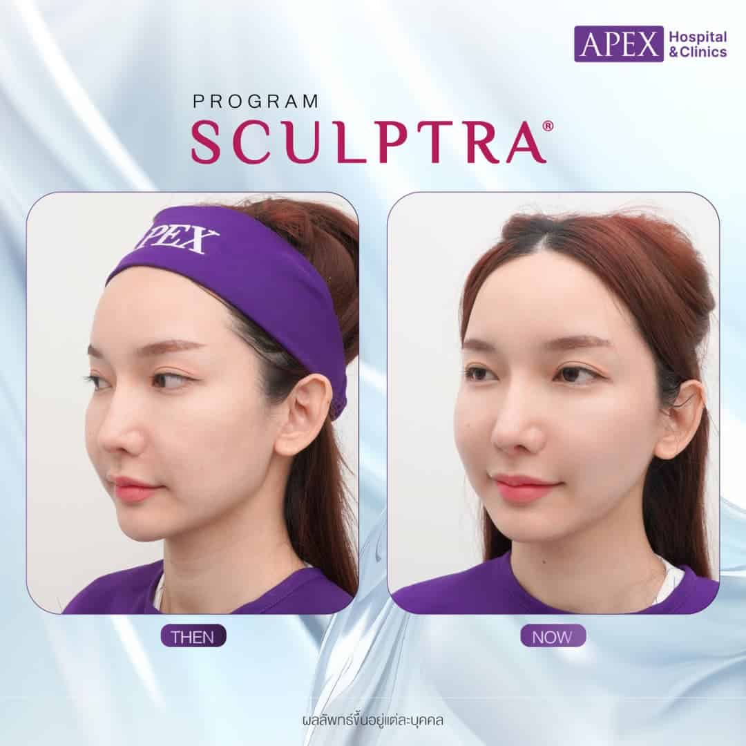 รีวิวโปรแกรม Sculptra